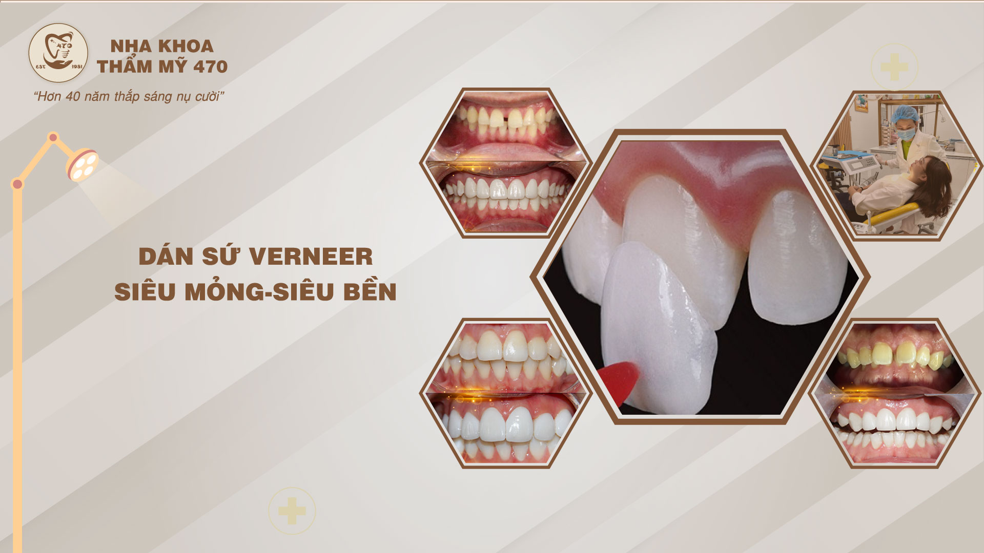 DÁN SỨ VENEER