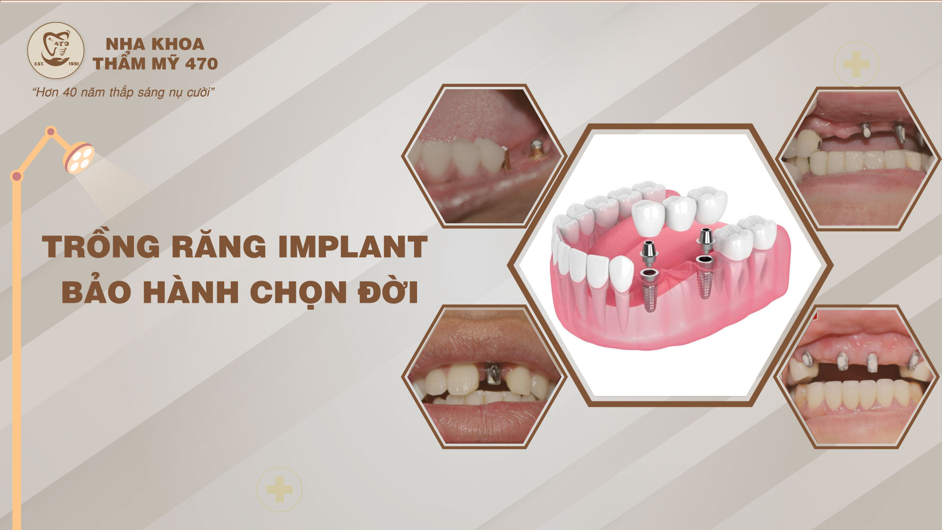 trồng răng Implant